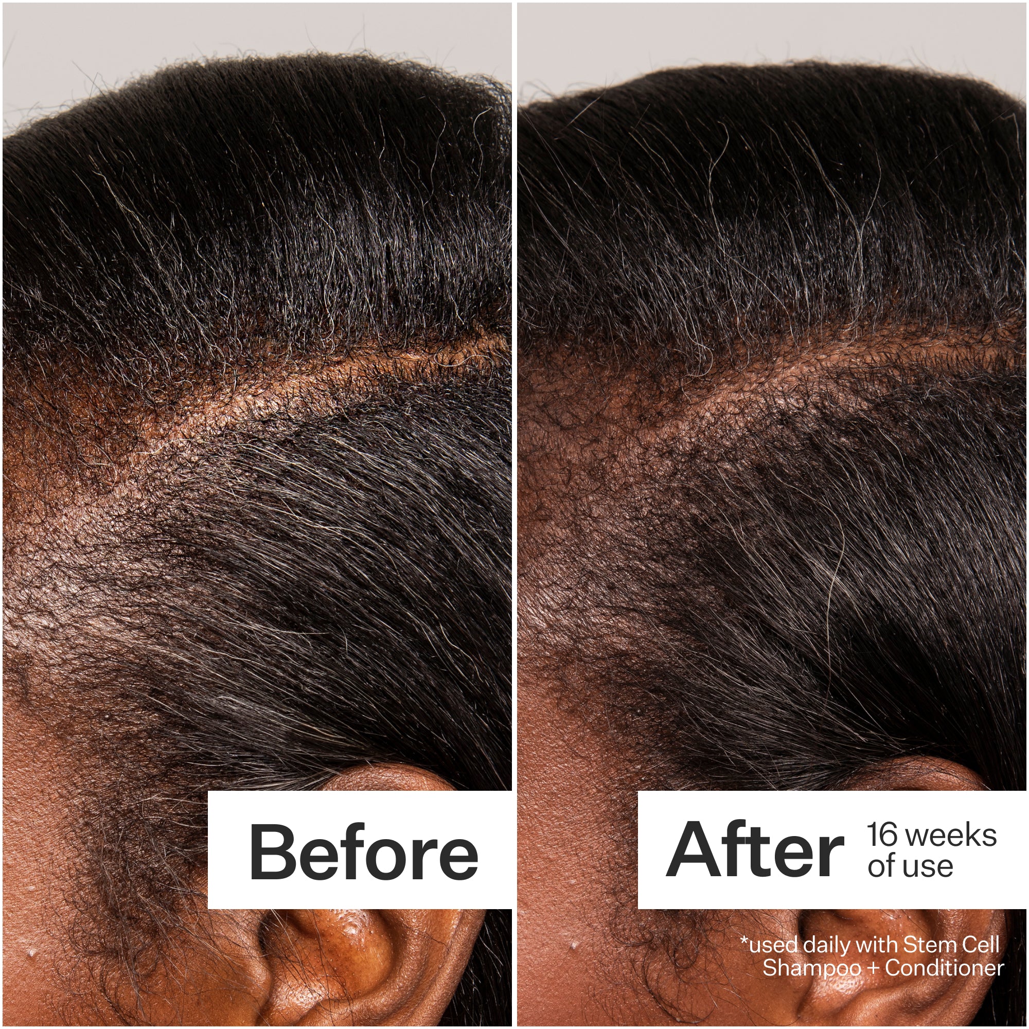 Act+Acre 3% Stem Cell Peptide Treatment